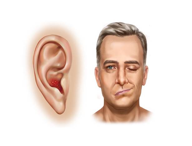 زونای گوش چیست؟و چه علائمی دارد؟
