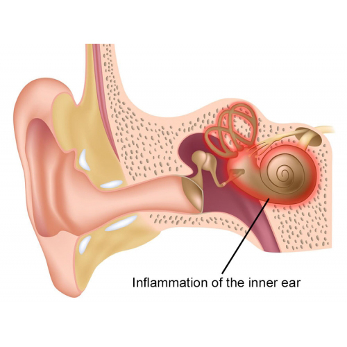 لابیرنتیت یا عفونت گوش داخلی چیست؟