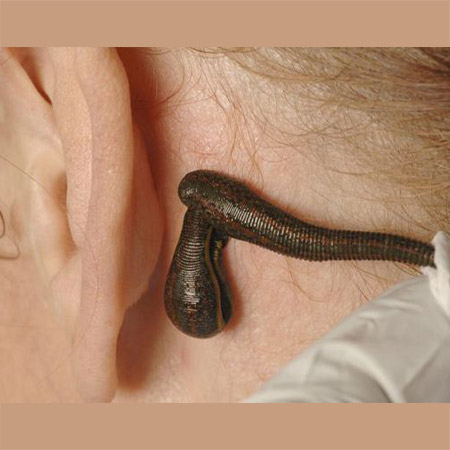 زالو درمانی در بیماری های گوش