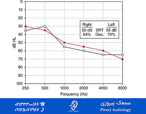 علائم پیرگوشی