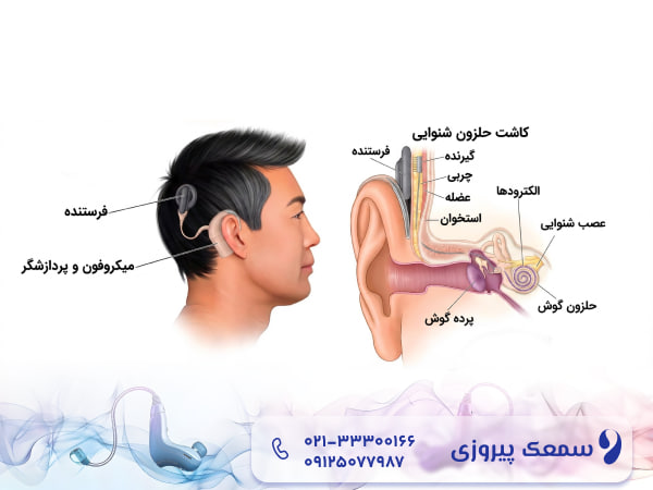درمان کم شنوایی بدون سمعک