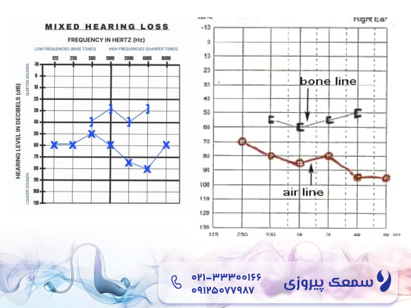 کم شنوایی آمیخته