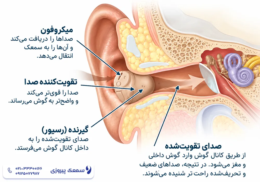سمعک پشت گوشی بهتر است یا داخل گوشی