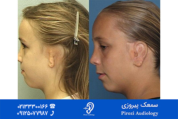 درمان کم شنوایی کودکان