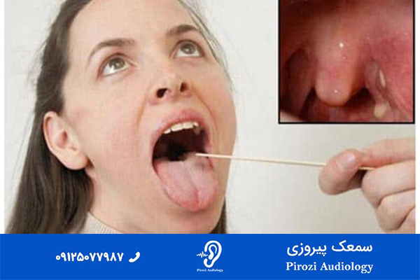 راه های تشخیص لوزه سوم