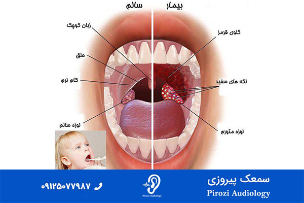 علائم لوزه سوم در کودکان