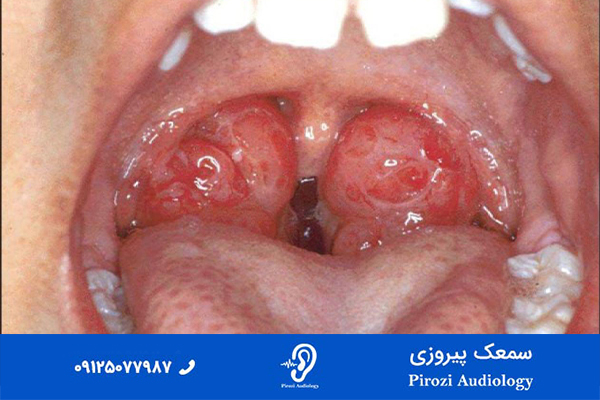 لوزه سوم چیست؟